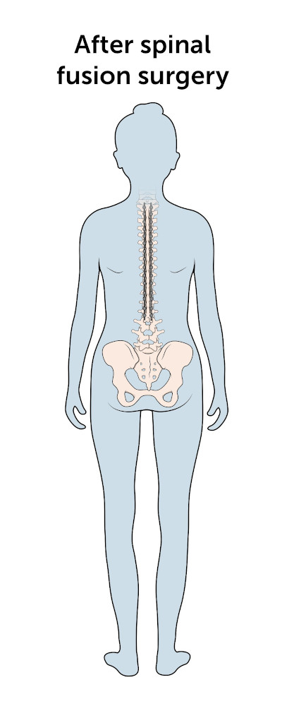 After spinal fusion surgery, the spine is stabilized in an upright position with metal rods and screws.