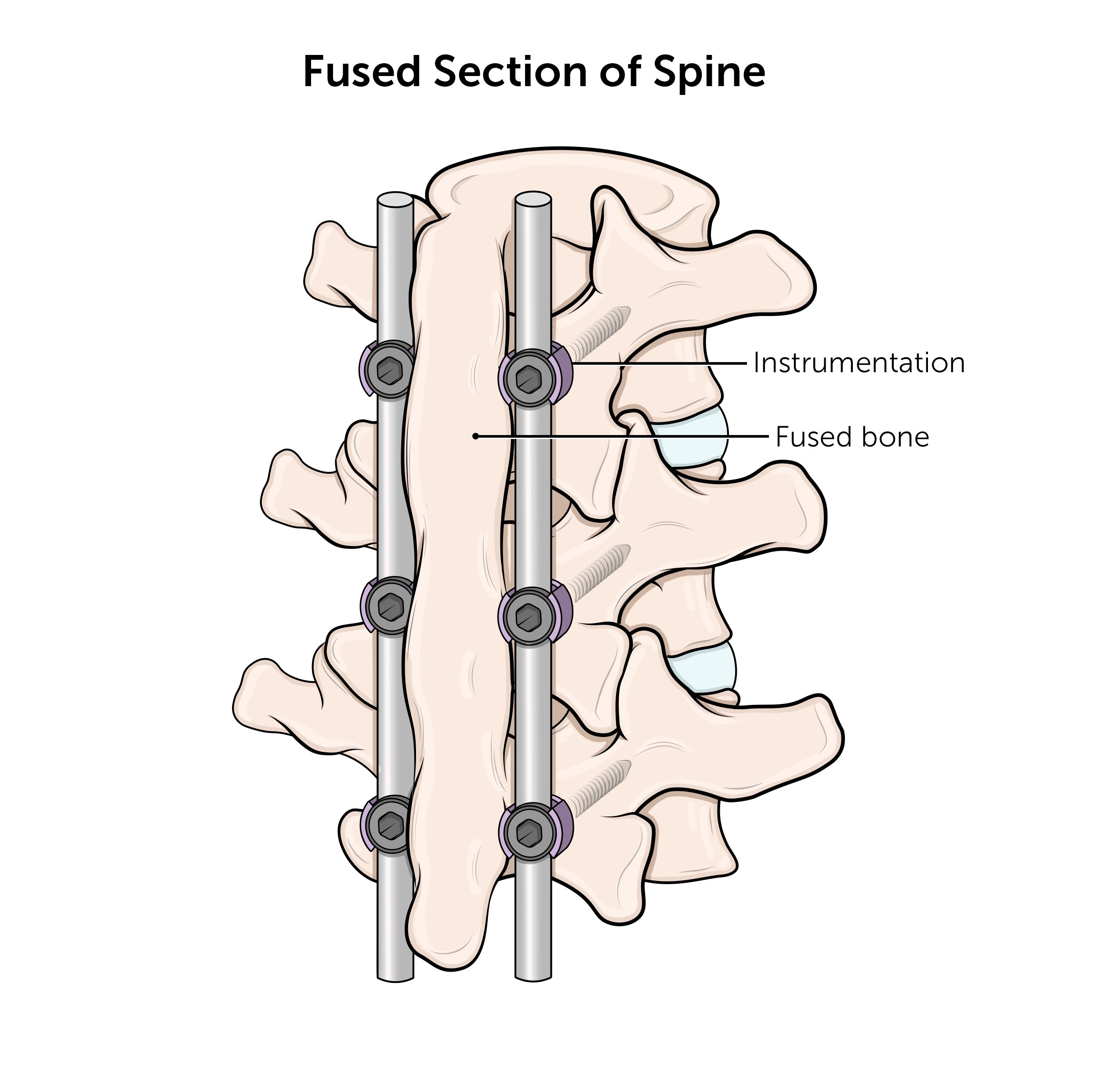 After spinal fusion surgery, rods and screws hold the fused section of the spine straight and the vertebrae have fused.