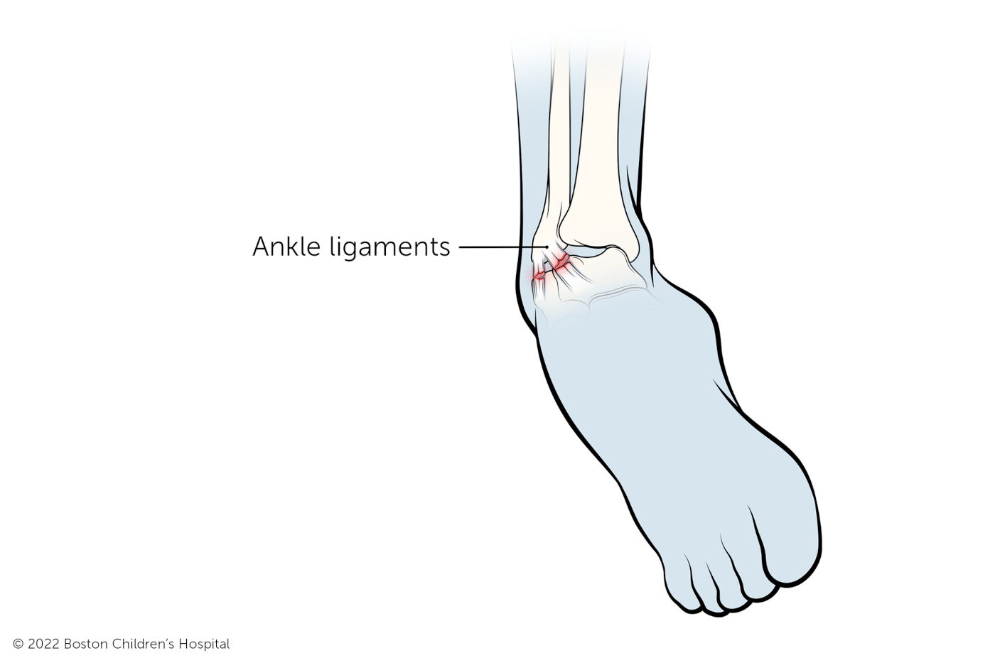 A sudden twisting motion strains the ankle ligaments.