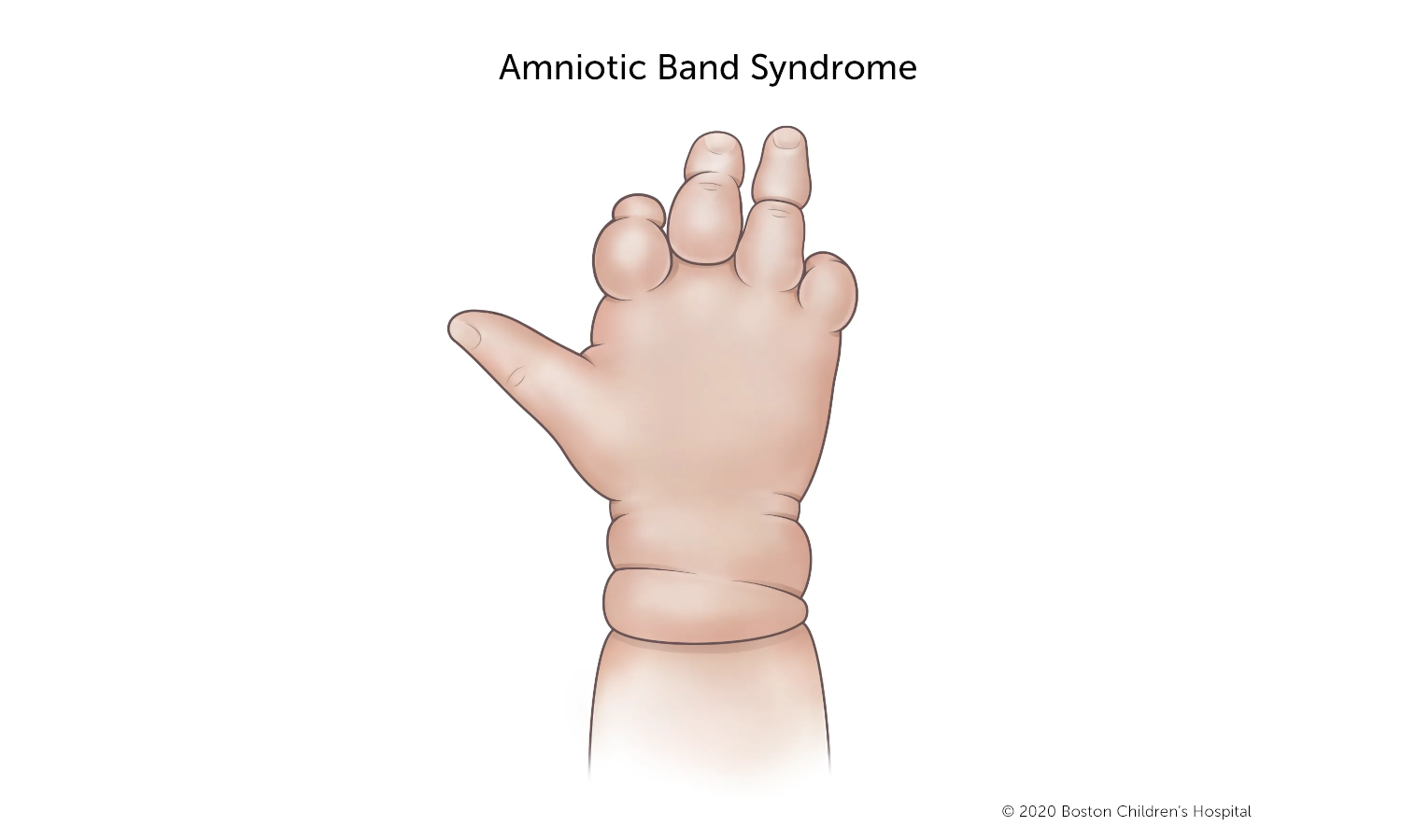 A hand with amniotic band syndrome has indented bands that wrap around the wrist and several fingers. Some of the bands are shallow. Other bands are deep and have changed the shape of the finger.