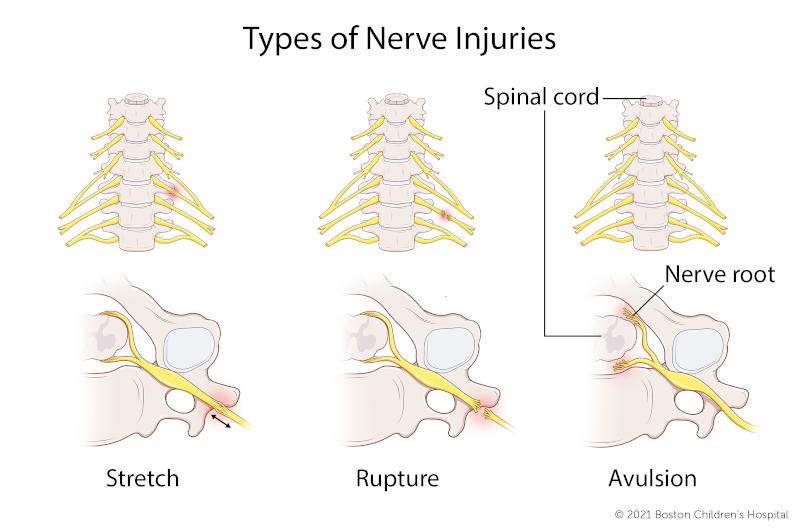 In a stretch brachial plexus injury, the nerve has been stretched, but not torn. In a rupture brachial plexus injury, the nerve has been torn, but remains attached to the spinal cord. In an avulsion brachial plexus injury, the nerve root has separated fro