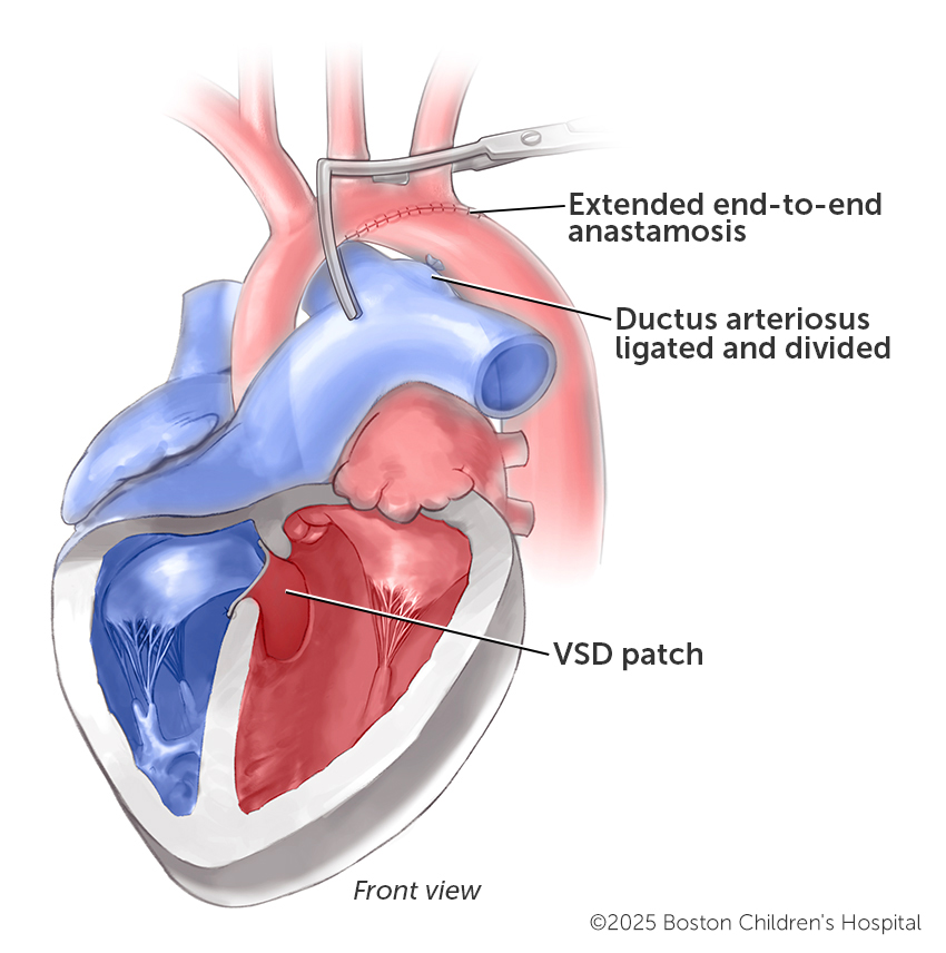 Medical illustration of three of the steps in the surgical repair of simple coarctation of the aorta with ventricular septal defect.