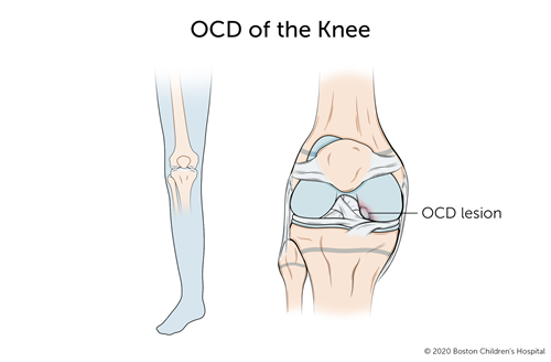 With osteochondritis dissecans of the knee, a segment of bone in the knee joint separates from the rest of the bone.