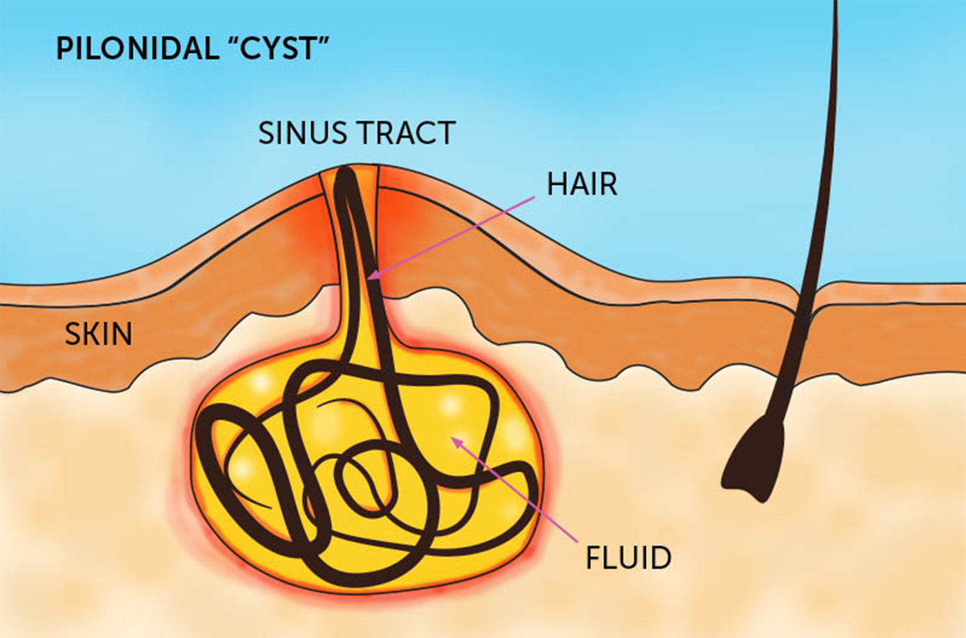 A pilonidal cyst under the skin with trapped hair and fluid in the sinus tract.