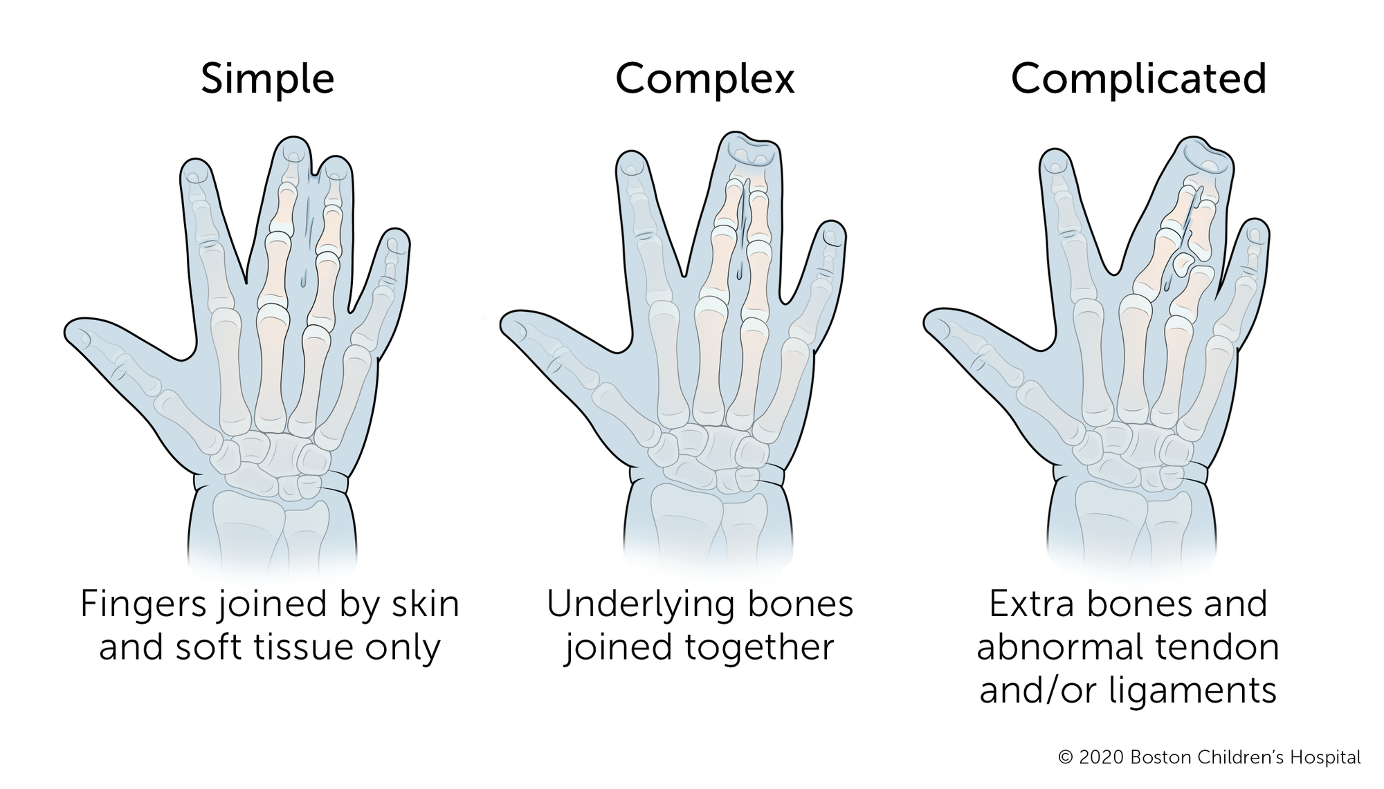 Simple syndactyly means that the fingers are joined by skin and soft tissue only. Complex syndactyly means that underlying bones are also joined together. Complicated syndactyly means that there are extra bones and abnormal tendon and/or ligament developm