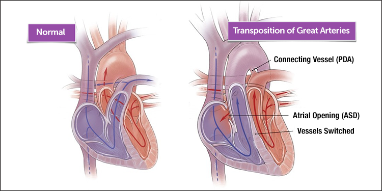 Illustration of a normal heart and a heart with transposition of the great arteries (TGA)