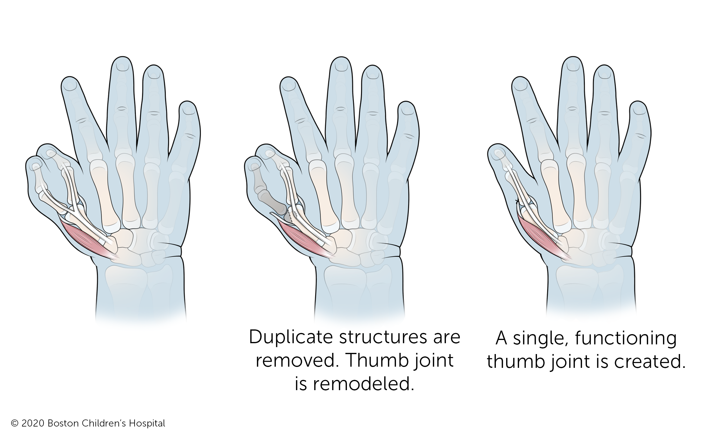 he duplicate bone and other structures are removed and the thumb joint where the two bones previously branched off is remodeled to create a single, functioning thumb and thumb joint.