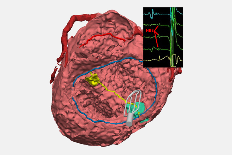 Illustration: An electrophysiology catheter