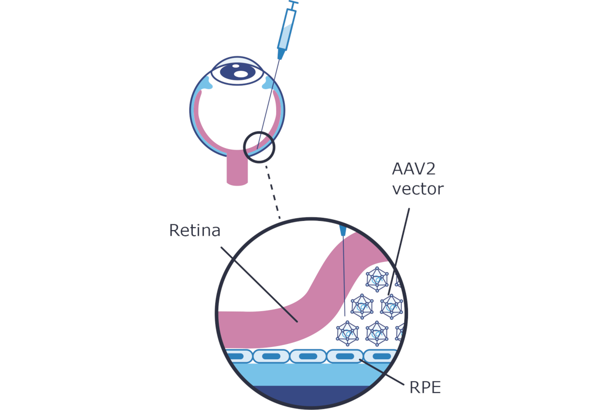 A drawing of the eye and retina, showing the Luxturna AAV2 vector injected between the retina and the retinal pigment epithelium.