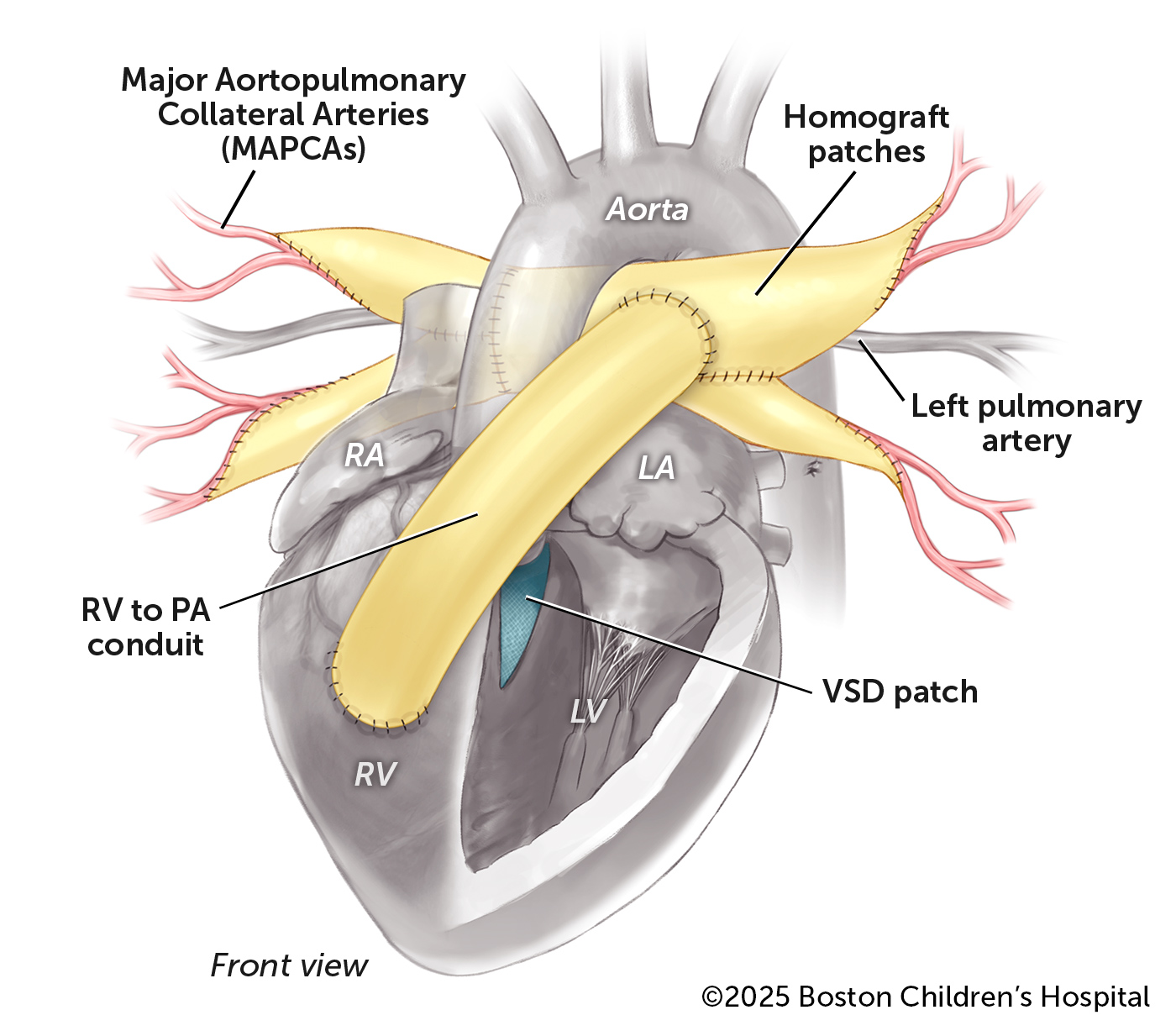 A medical illustration of a heart after surgery for tetralogy of Fallot (ToF) with pulmonary atresia and major aortopulmonary collateral arteries (MAPCAs).