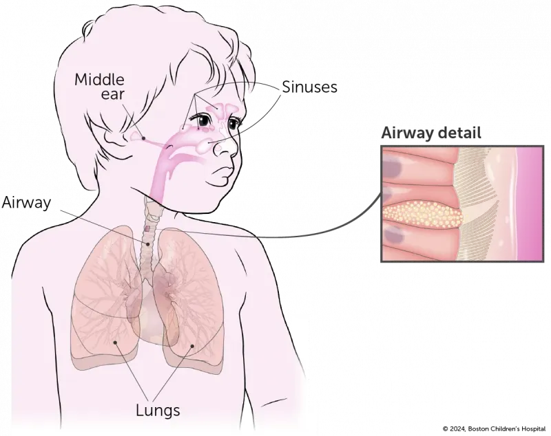 An illustration shows the anatomy of a child who has primary ciliary dyskinesia (PCD) with heterotaxy.