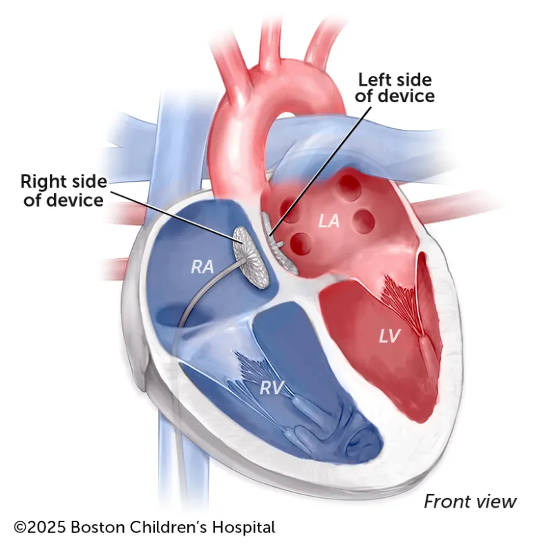 A medical illustration of a device closing the hole caused by an atrial septal defect.