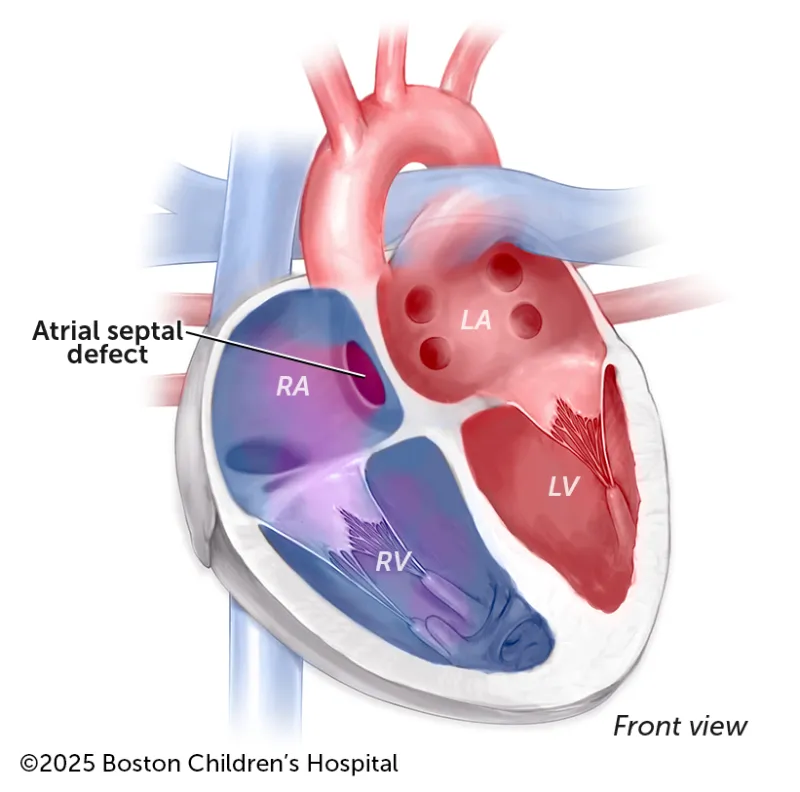 A medical illustration of an atrial septal defect.