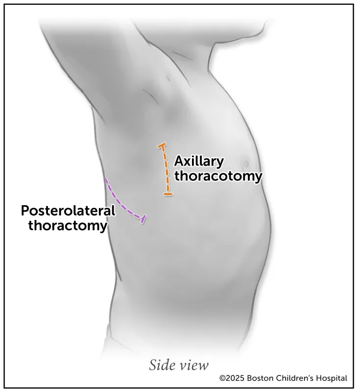 A medical illustration of the incision spots for posterolateral and axillary thoracotomy approaches to treating heart defects.