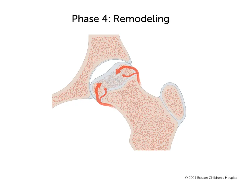 Phase 4: Remodeling. Healthy blood flow continues but the femoral head is flat and slightly indented and the gap in the hip socket remains.