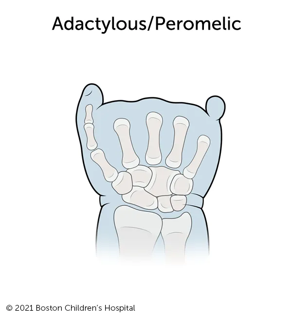 Illustration of adactylous/peromelic symbrachydactyly