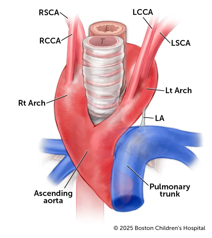 A medical illustration highlights key features of a double aortic arch.